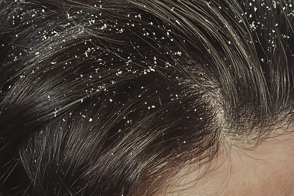 How to Get Rid of Dandruff Without Dandruff Shampoo: 12 Tips