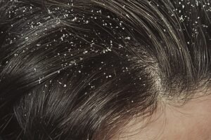 How to Get Rid of Dandruff Without Dandruff Shampoo: 12 Tips